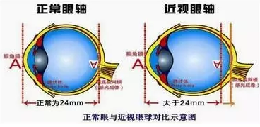 近視眼球突出？！控制近視度數(shù)加深是關(guān)鍵！