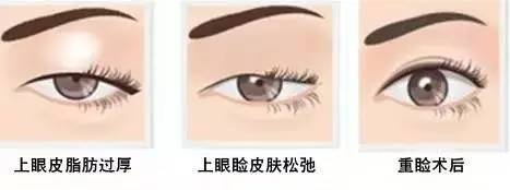 為什么要做雙眼皮？5個(gè)理由說服你！