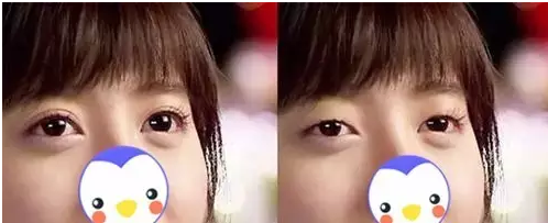 要不要做雙眼皮？別糾結(jié)了看這個！