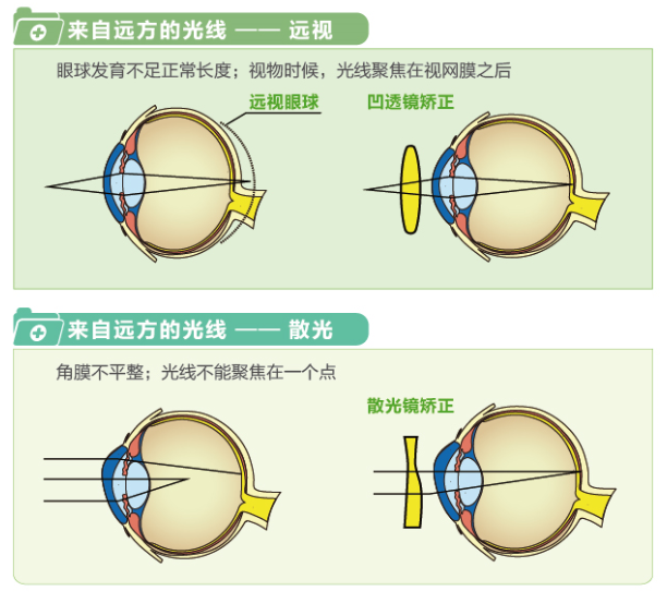 【看圖解】一張圖教你看懂近視、遠(yuǎn)視和散光