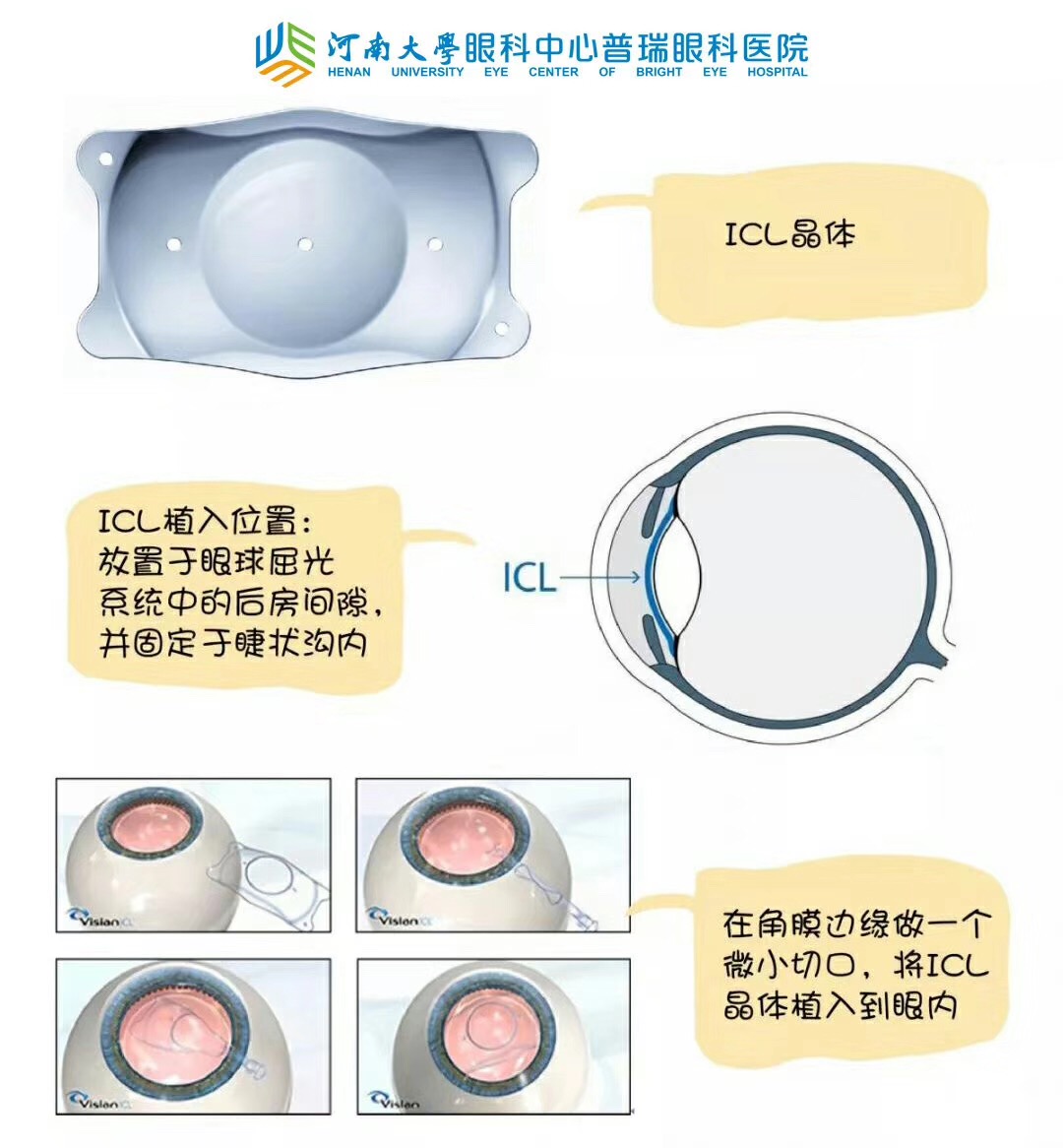 近視度數(shù)太高，還能做手術(shù)嗎？